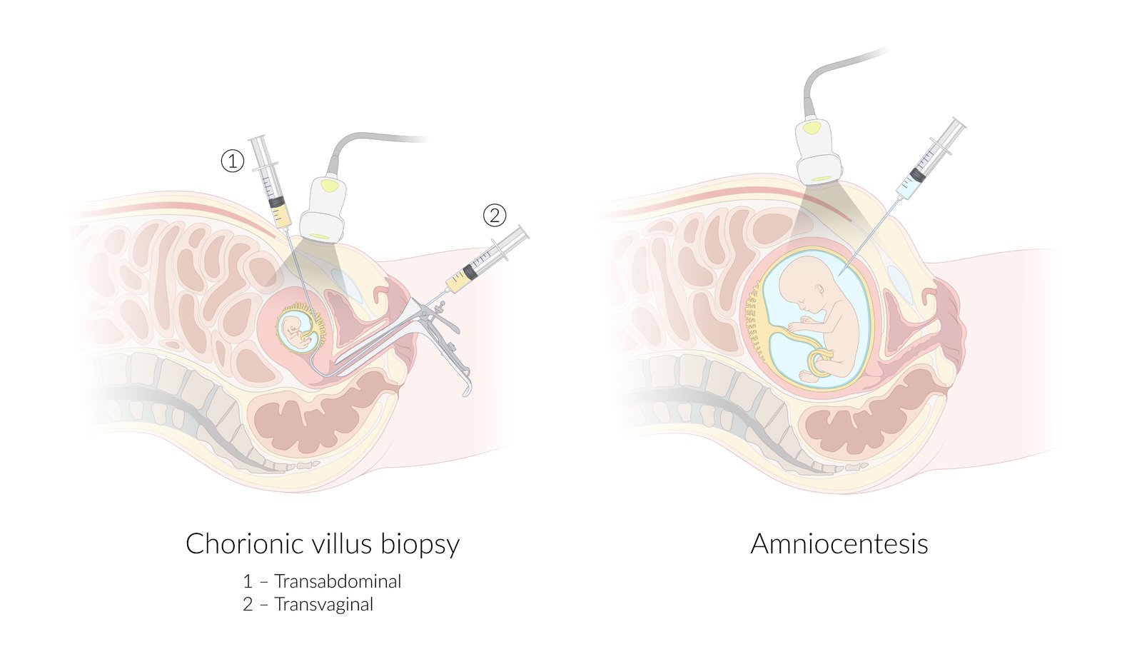 Chorionic villus biopsy and amniocentesis