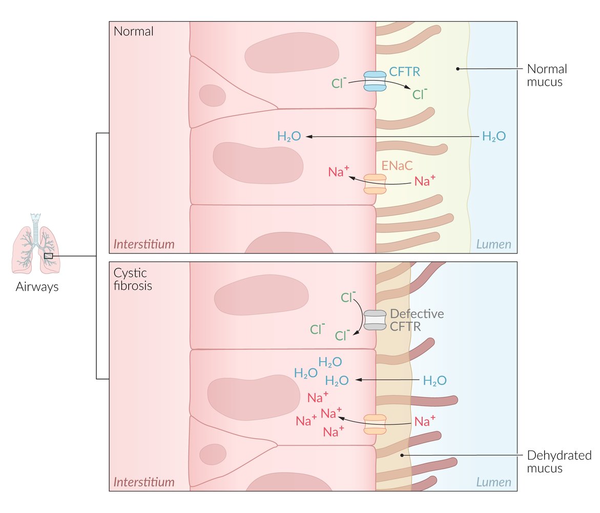 Cystic fibrosis pathophysiology