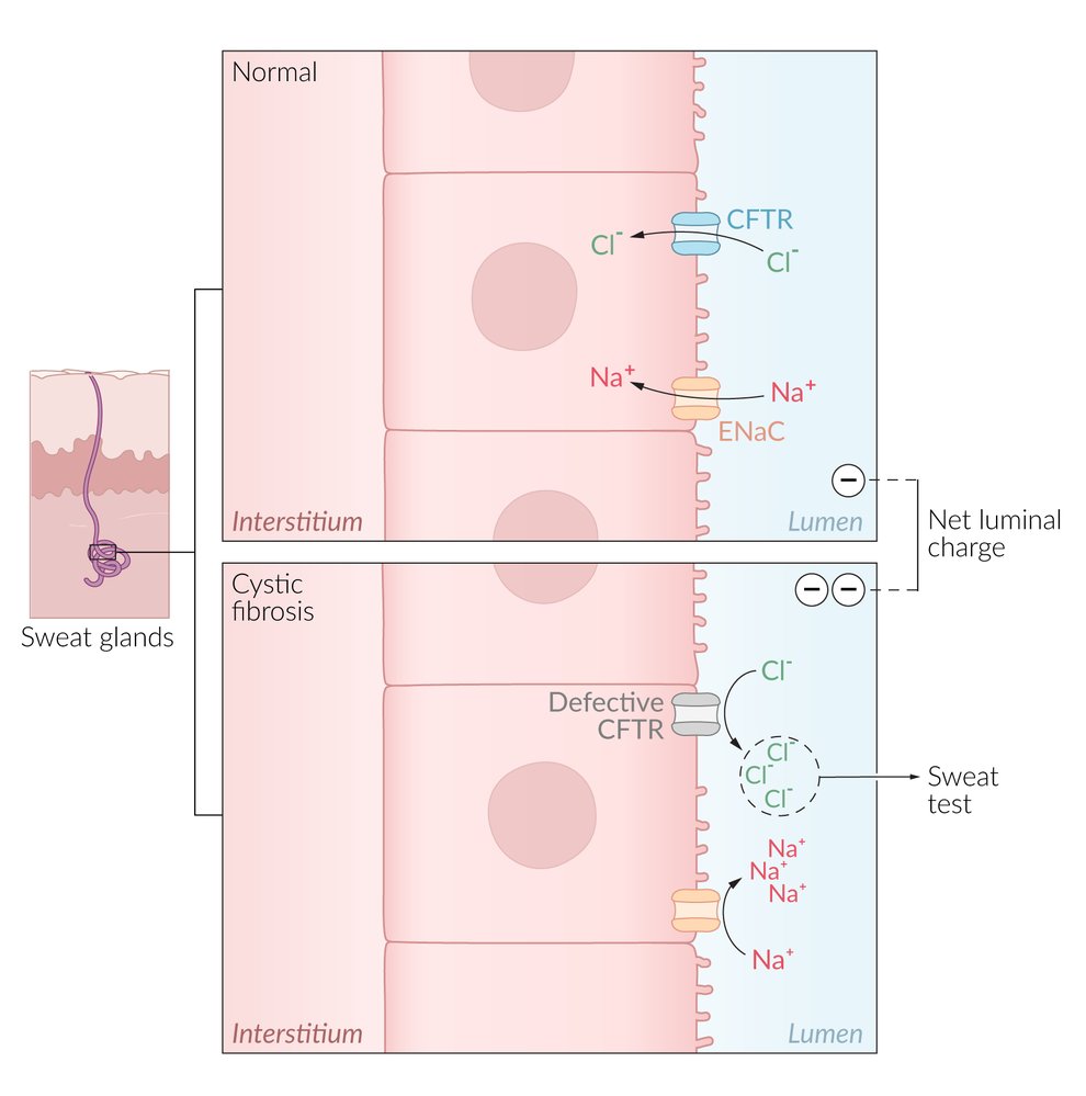 Cystic fibrosis sweat test