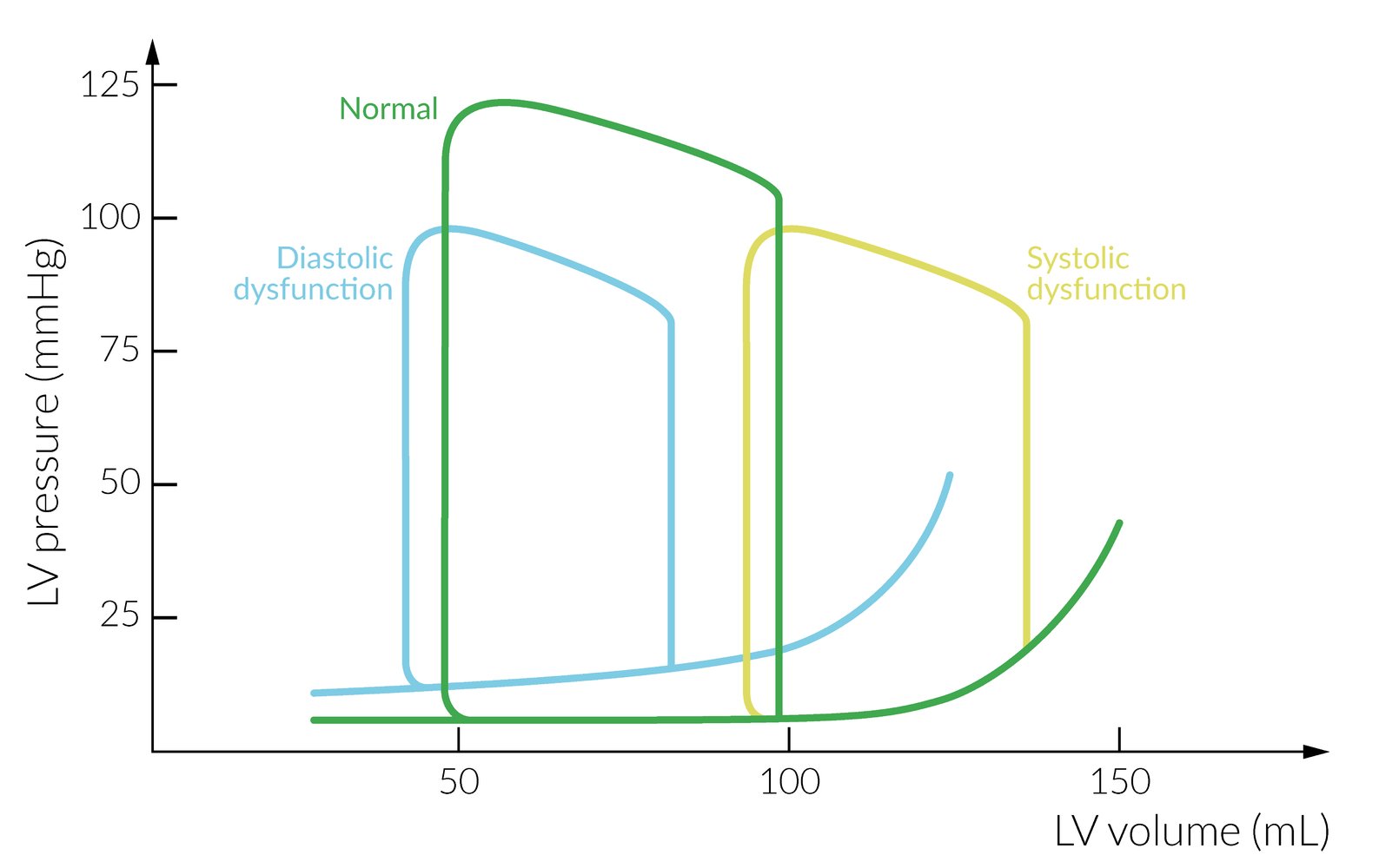 Pressure-volume loops of the left ventricle in systolic and diastolic dysfunction