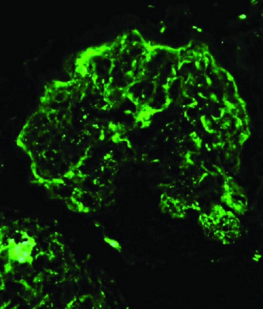 Acute poststreptococcal glomerulonephritis (APSGN)