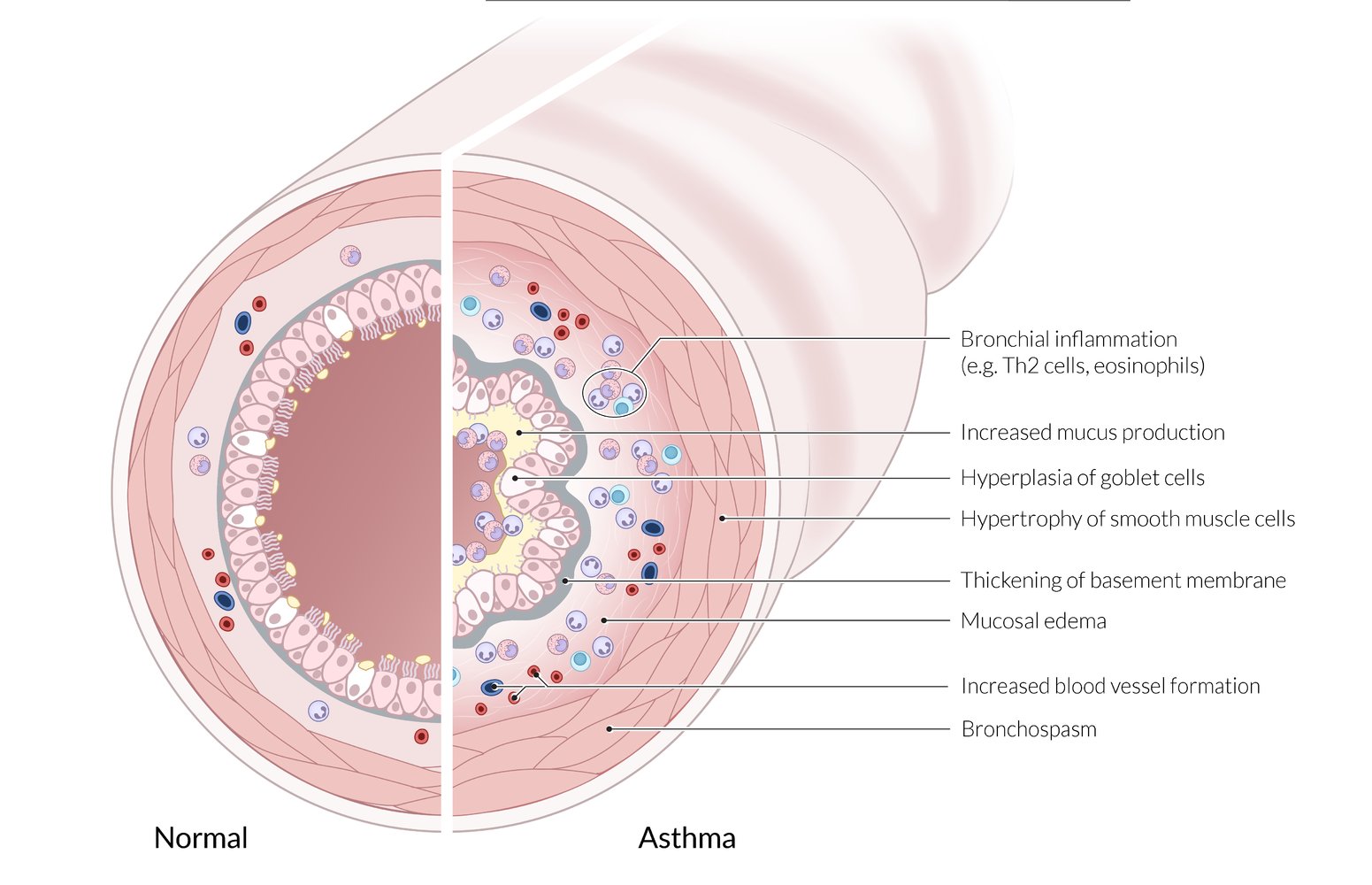 Pathophysiology of asthma