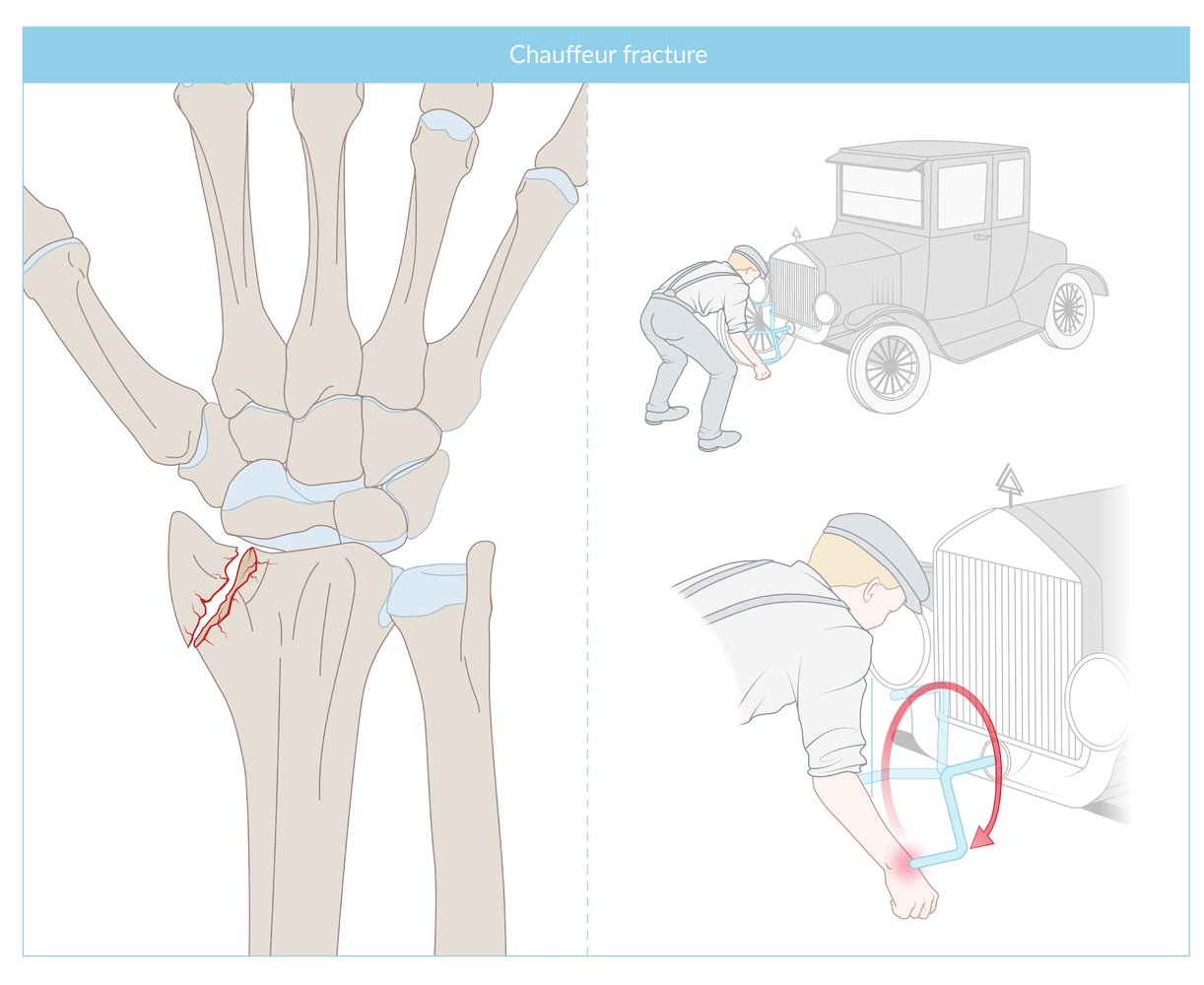 Chauffeur fracture (Hutchinson fracture)