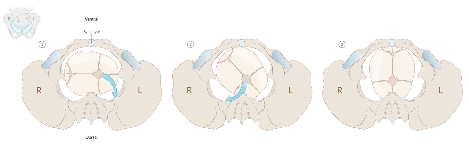 Normal childbirth from right occiput anterior position