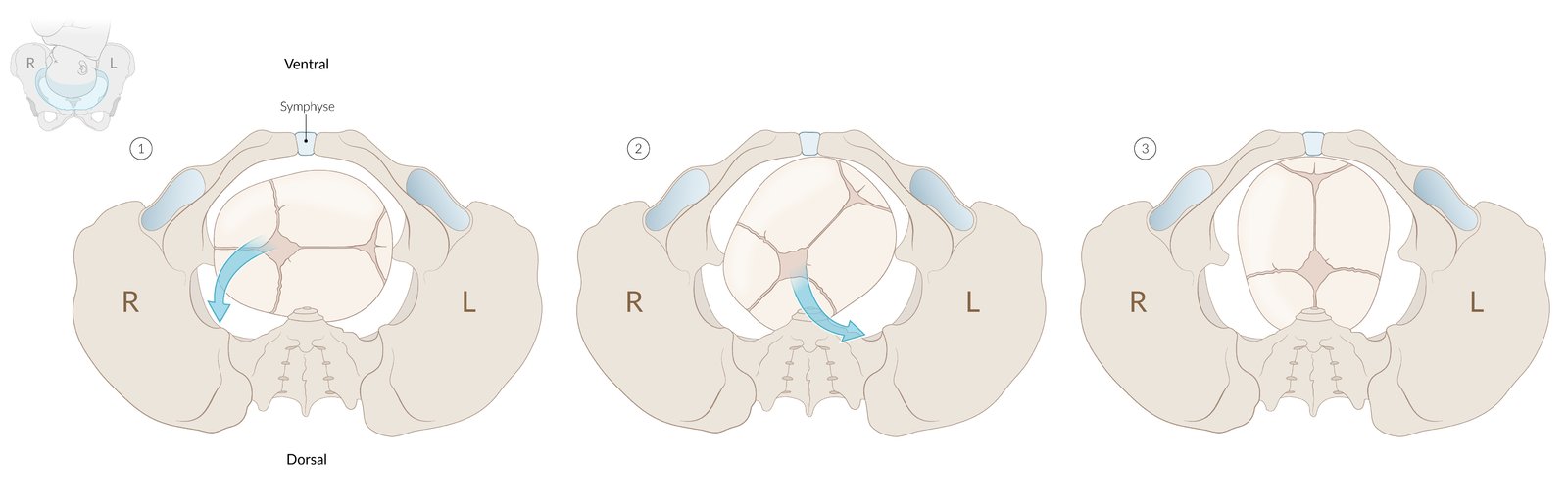 Normal childbirth from left occiput anterior position