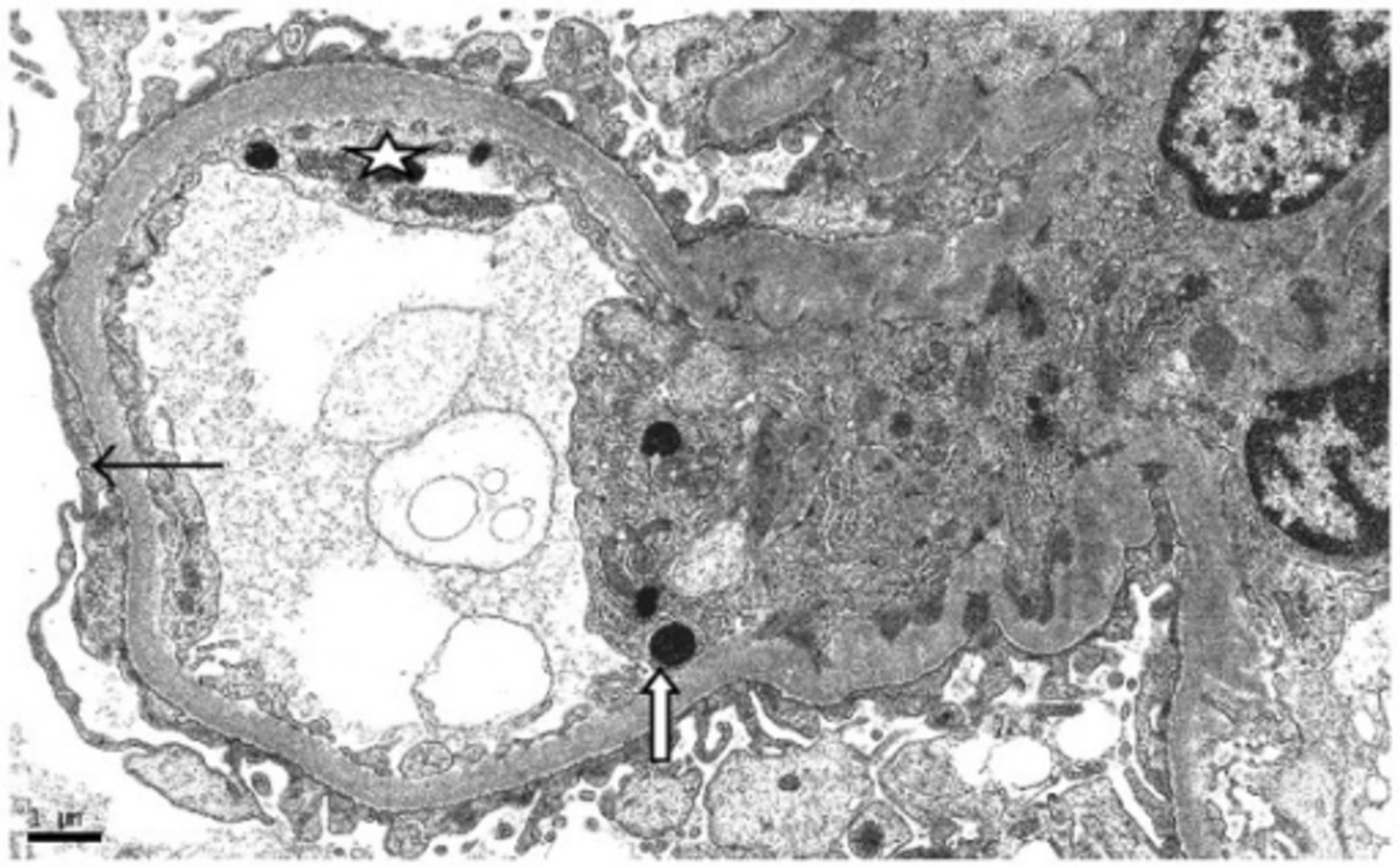 Focal segmental glomerulosclerosis