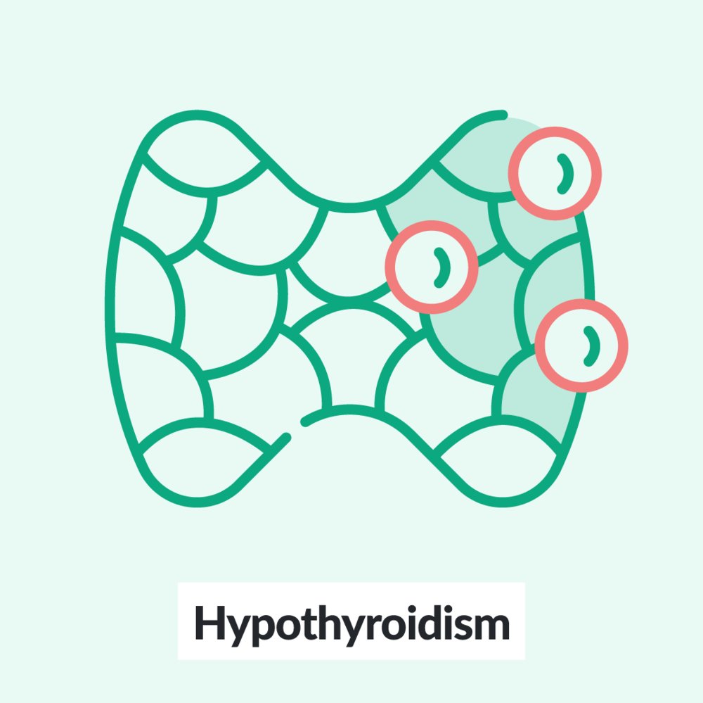 Chalk Talk: Hypothyroidism