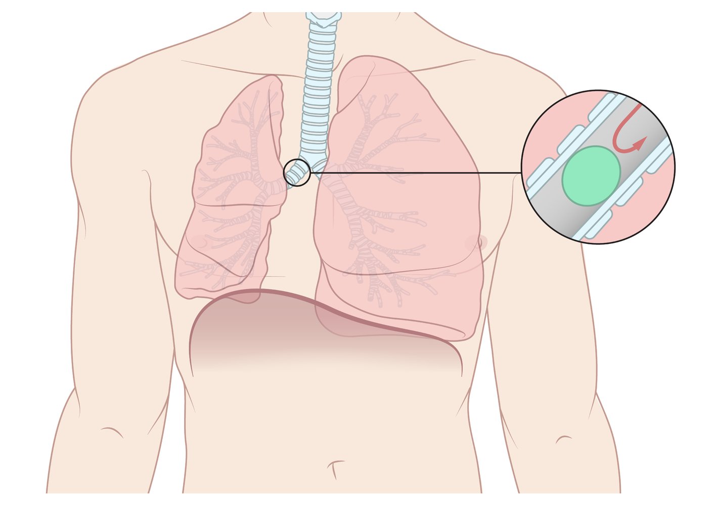 Atelectasis due to foreign body aspiration