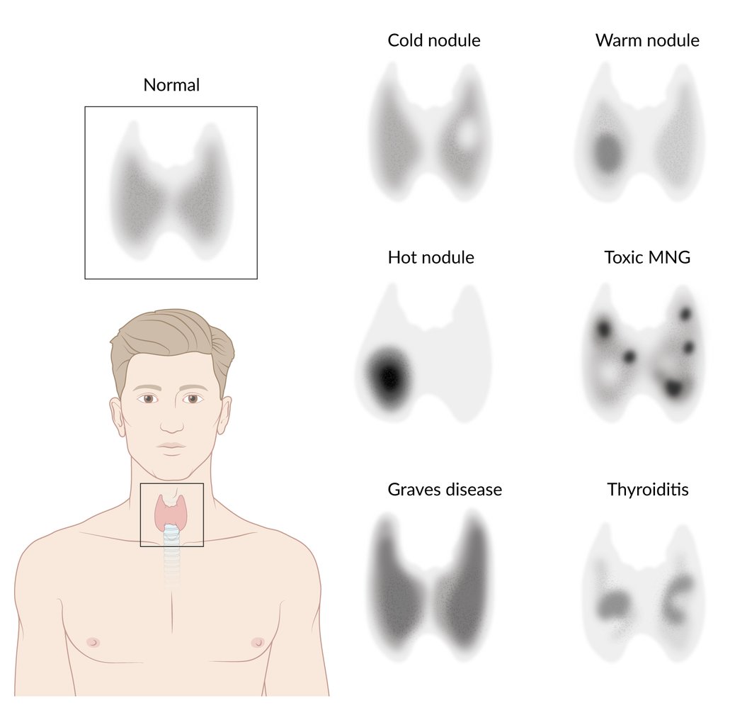 Thyroid scintigraphy