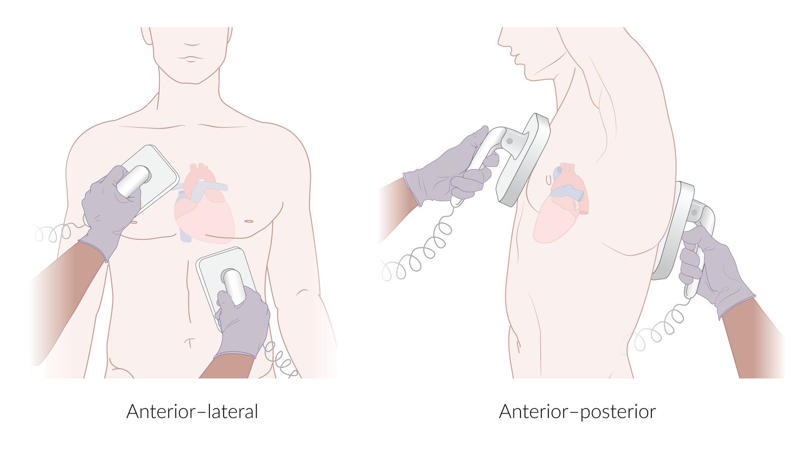 Placement of paddles for defibrillation or electrical cardioversion