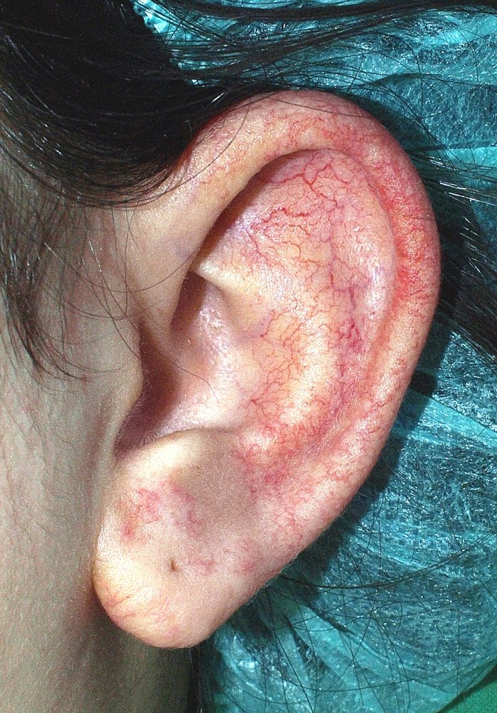 Telangiectasia