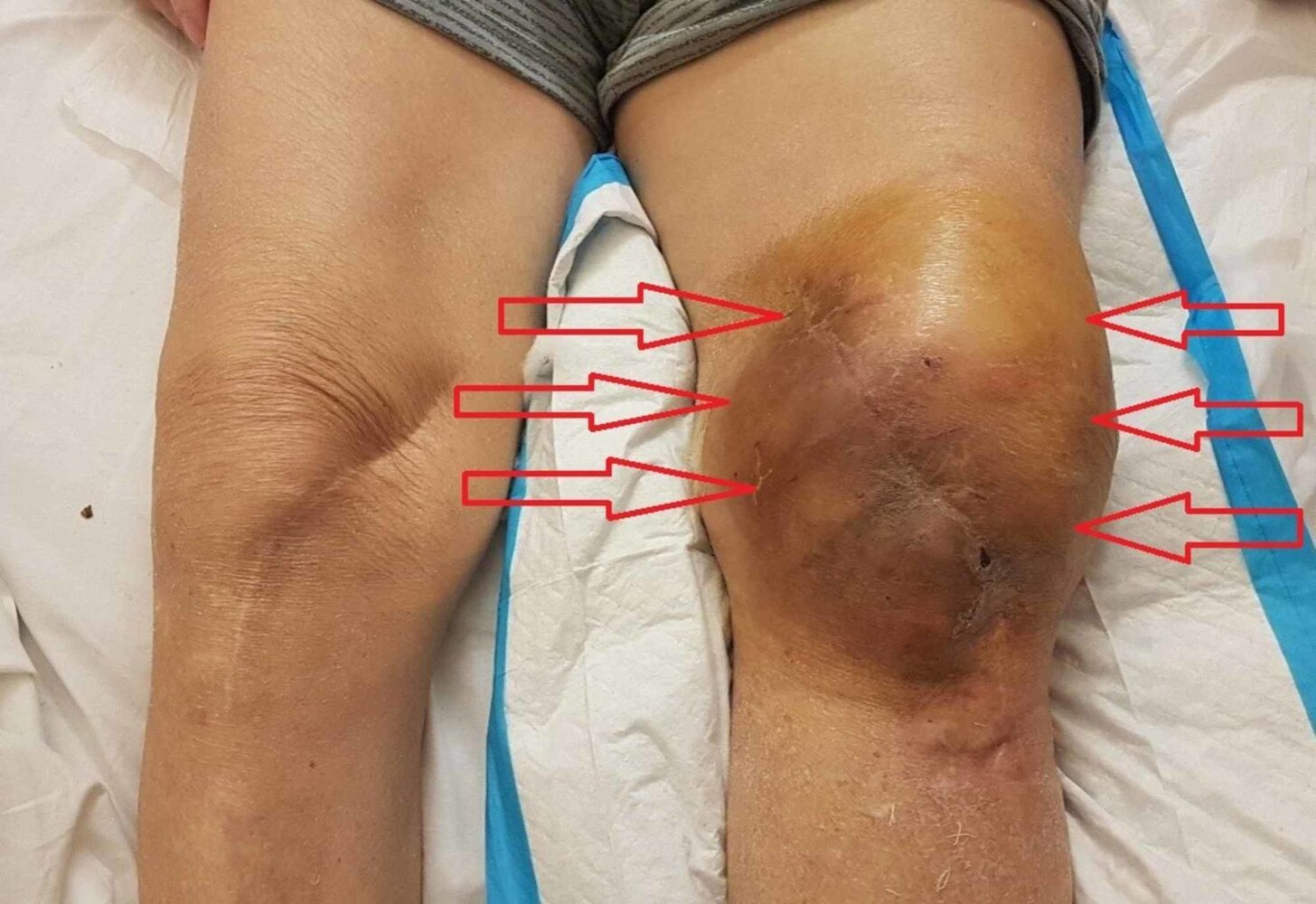 Hemarthrosis of the knee