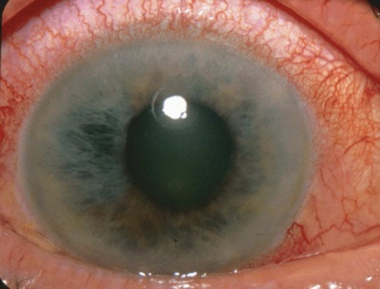 Angle-closure glaucoma