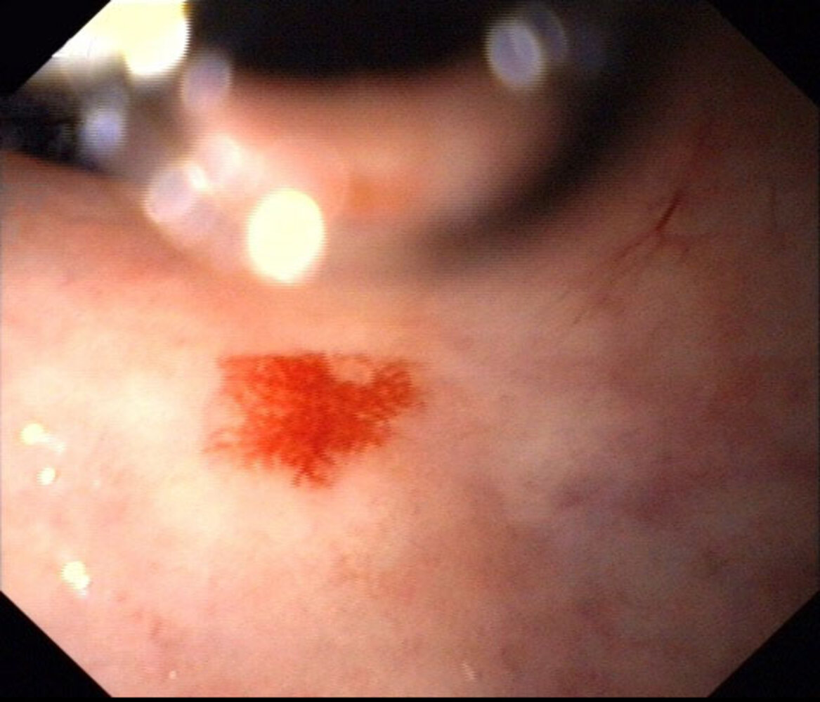 Angiodysplasia