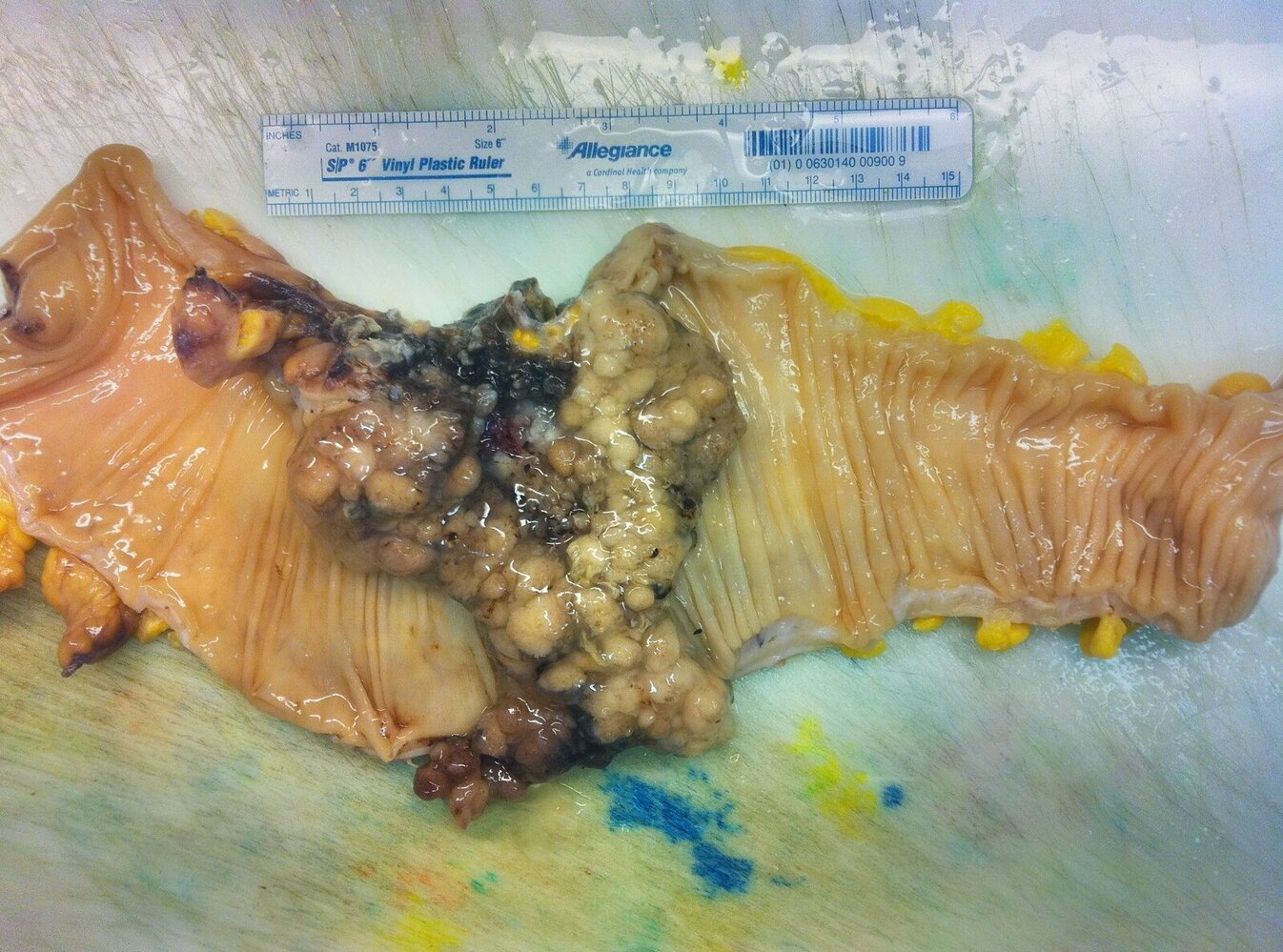 Colon cancer arising from adenoma