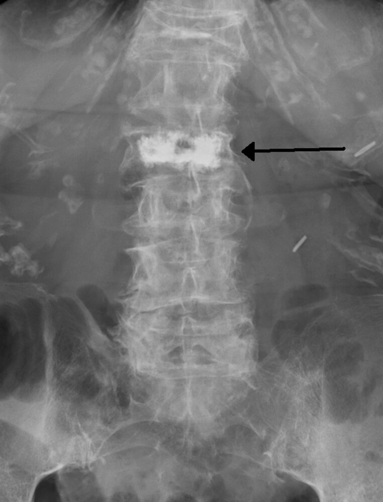 Vertebroplasty