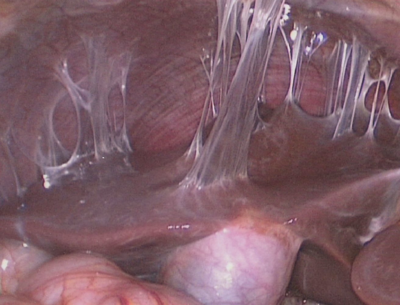 Fitz-Hugh-Curtis syndrome (perihepatitis)