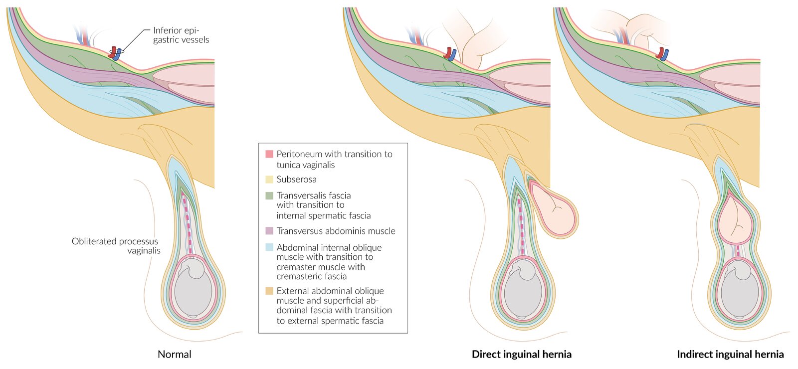Direct and indirect inguinal hernias