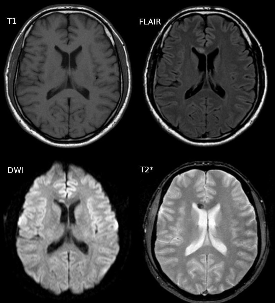 Diffuse axonal injury