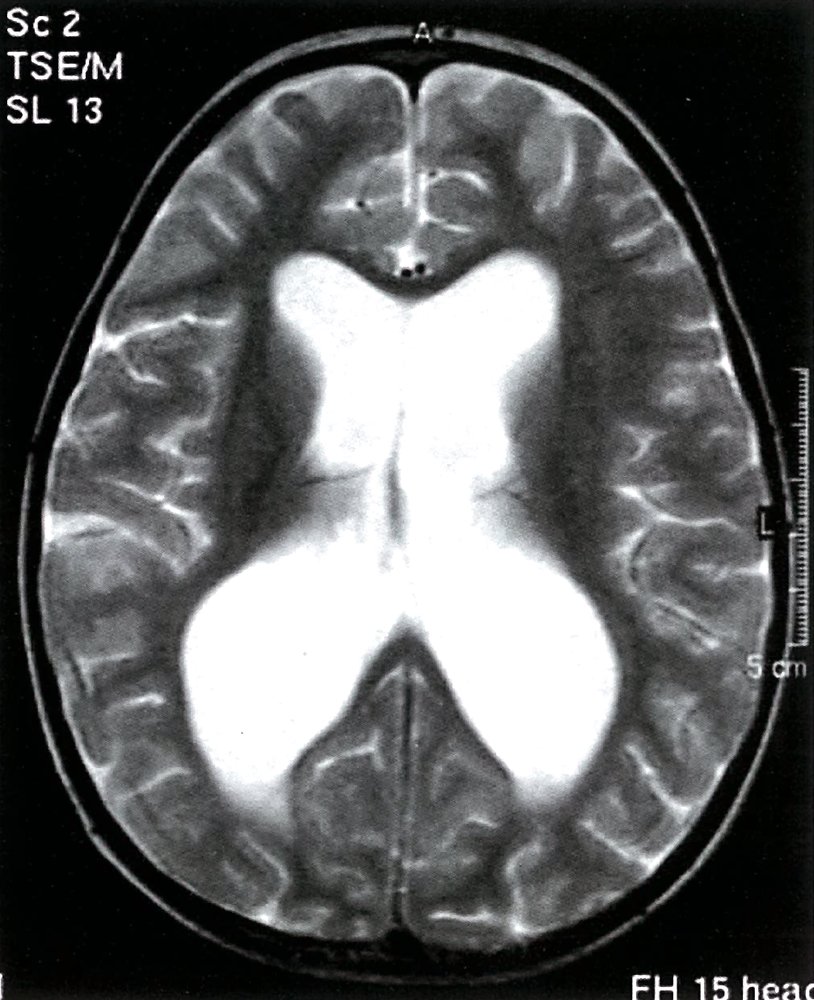 Noncommunicating hydrocephalus
