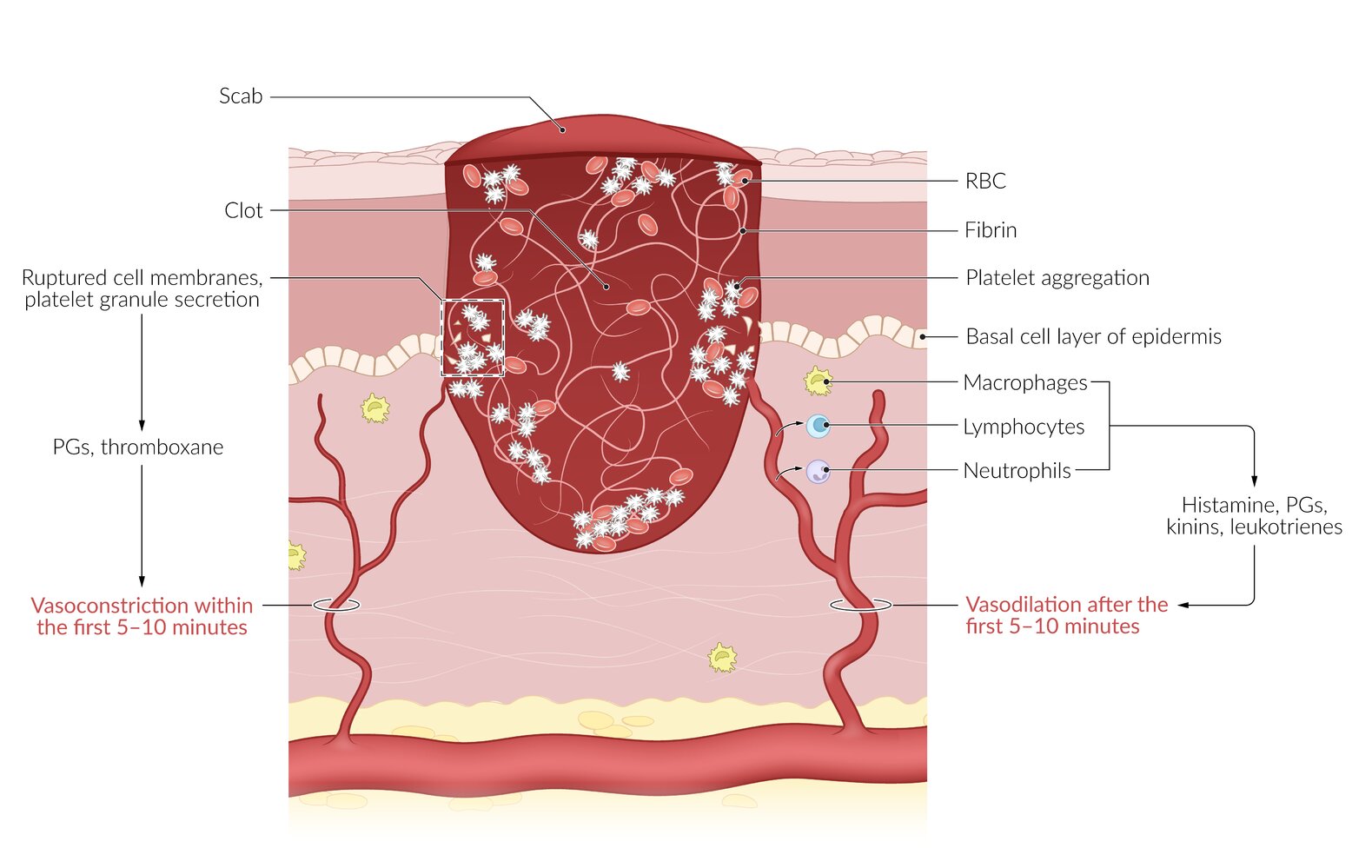 Exudative phase of wound healing