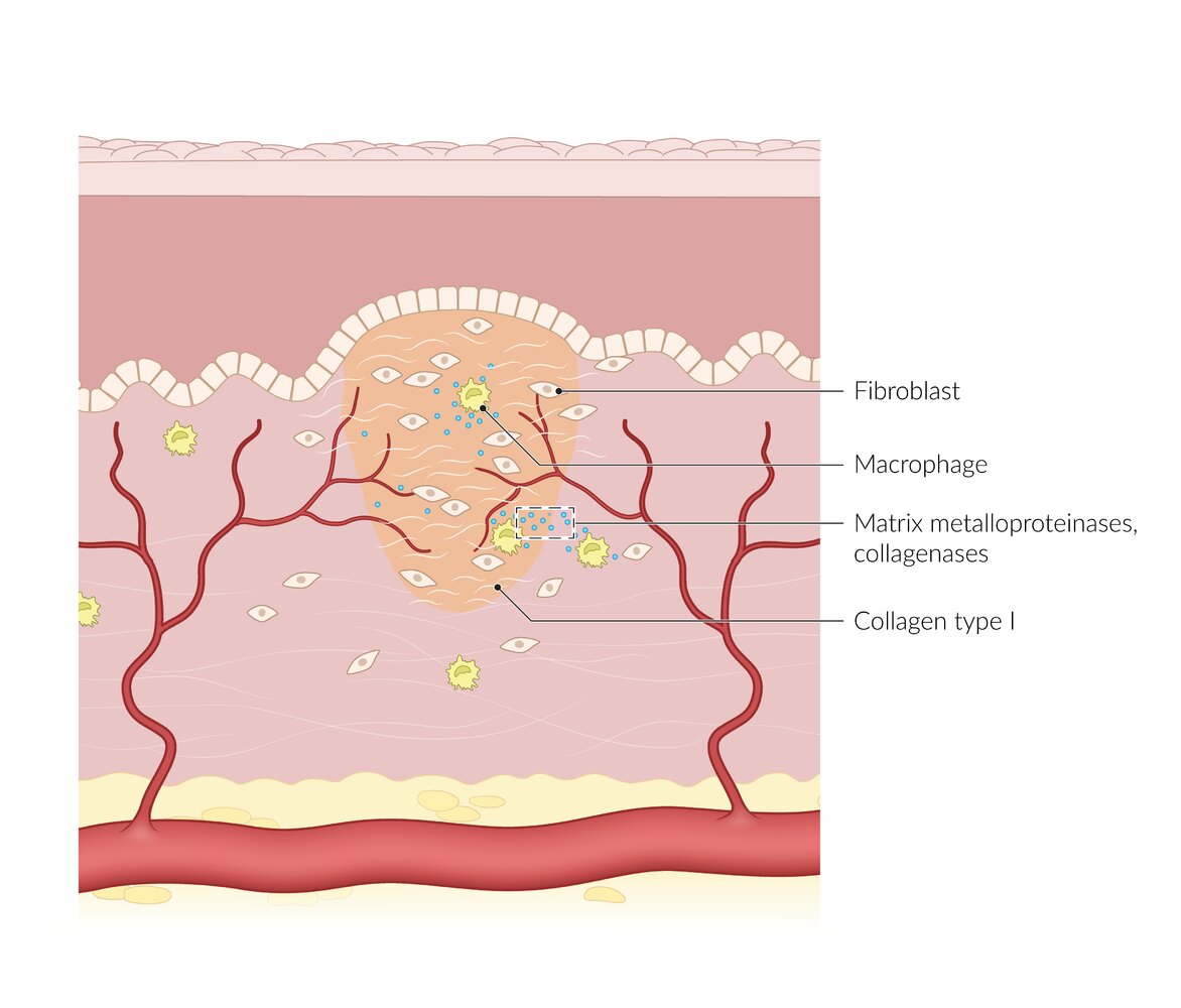 Maturation phase of wound healing
