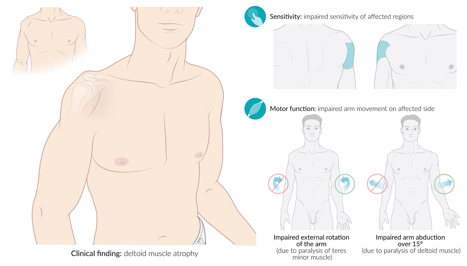 Clinical features of axillary nerve injury