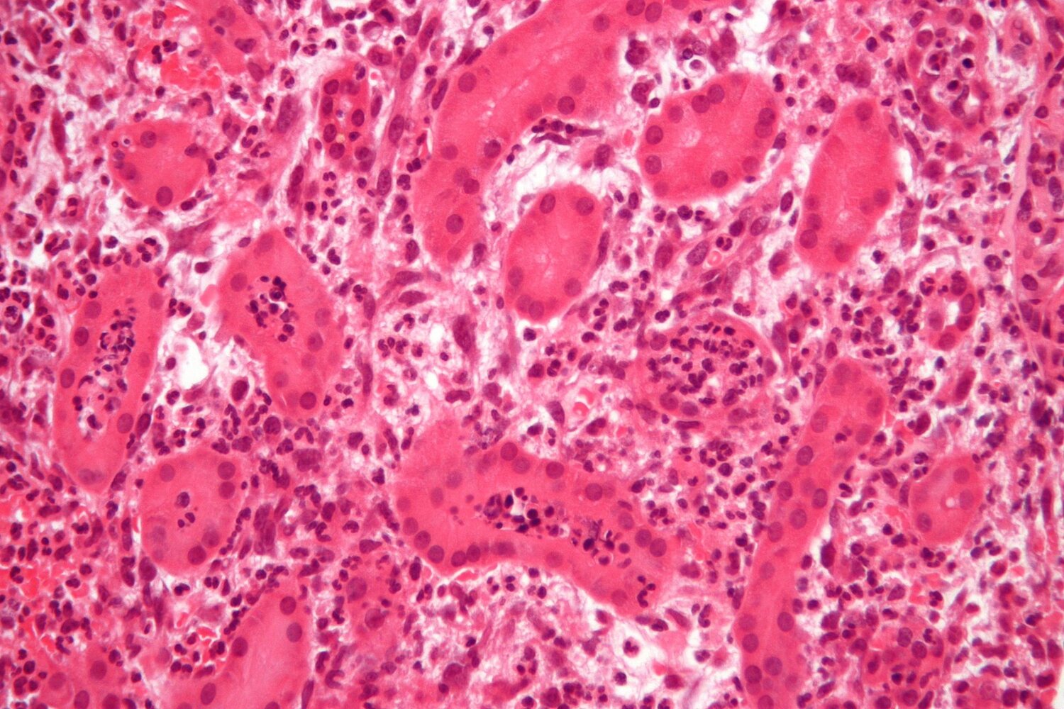 Acute pyelonephritis