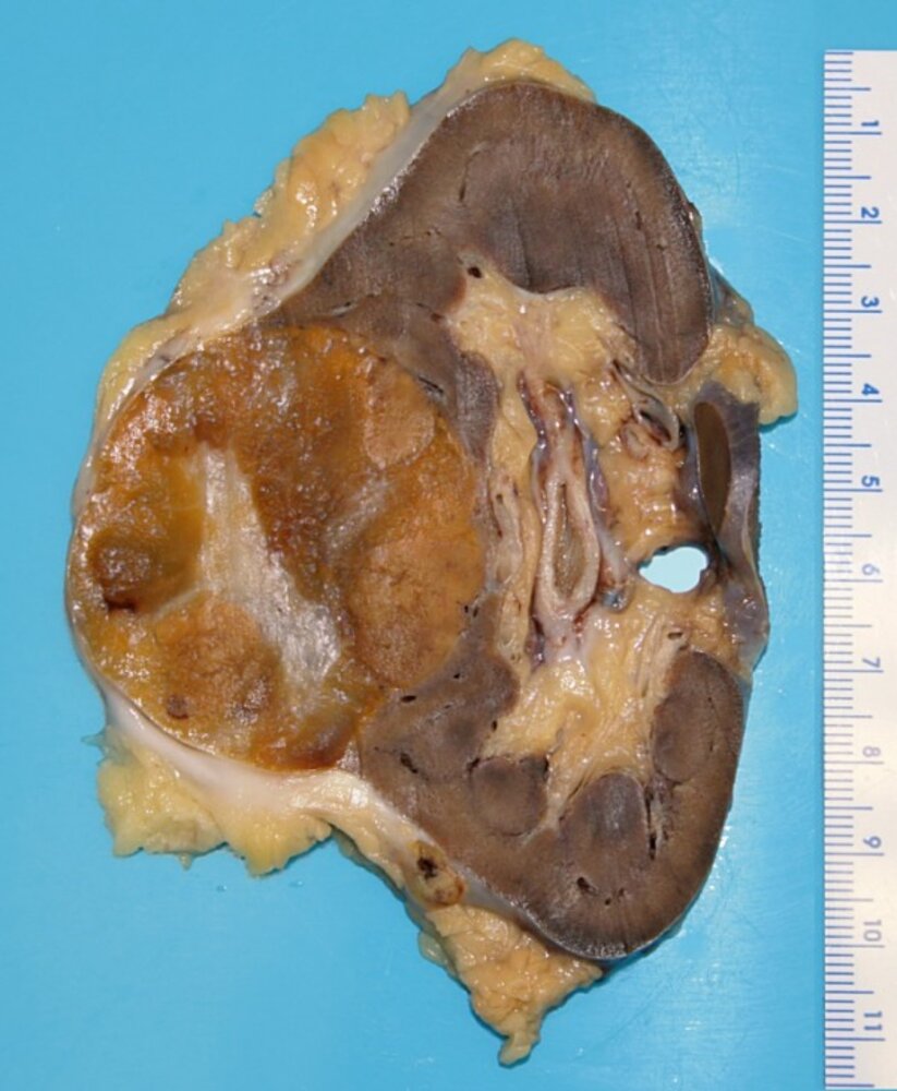 Renal oncocytoma