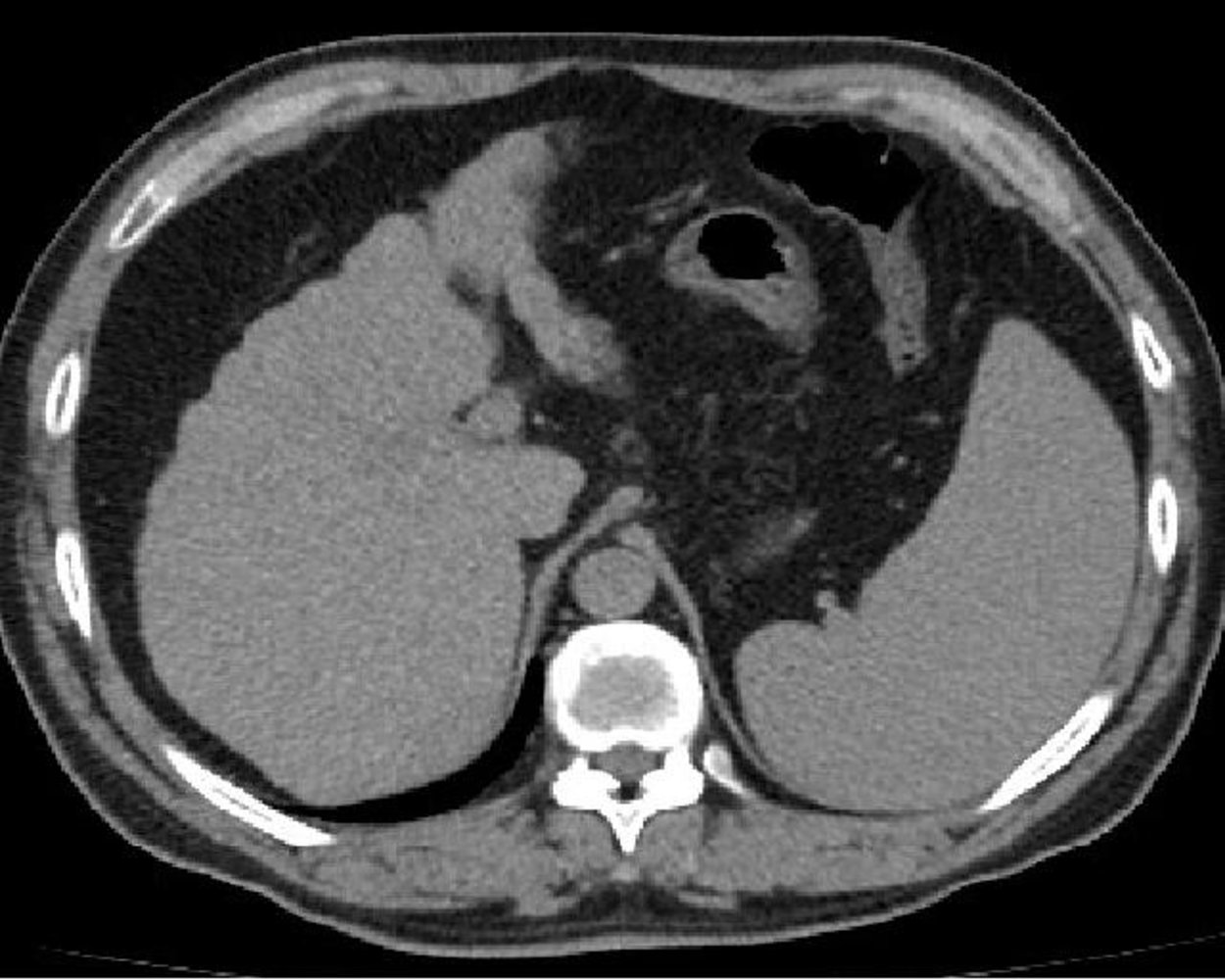Hepatic cirrhosis with splenomegaly