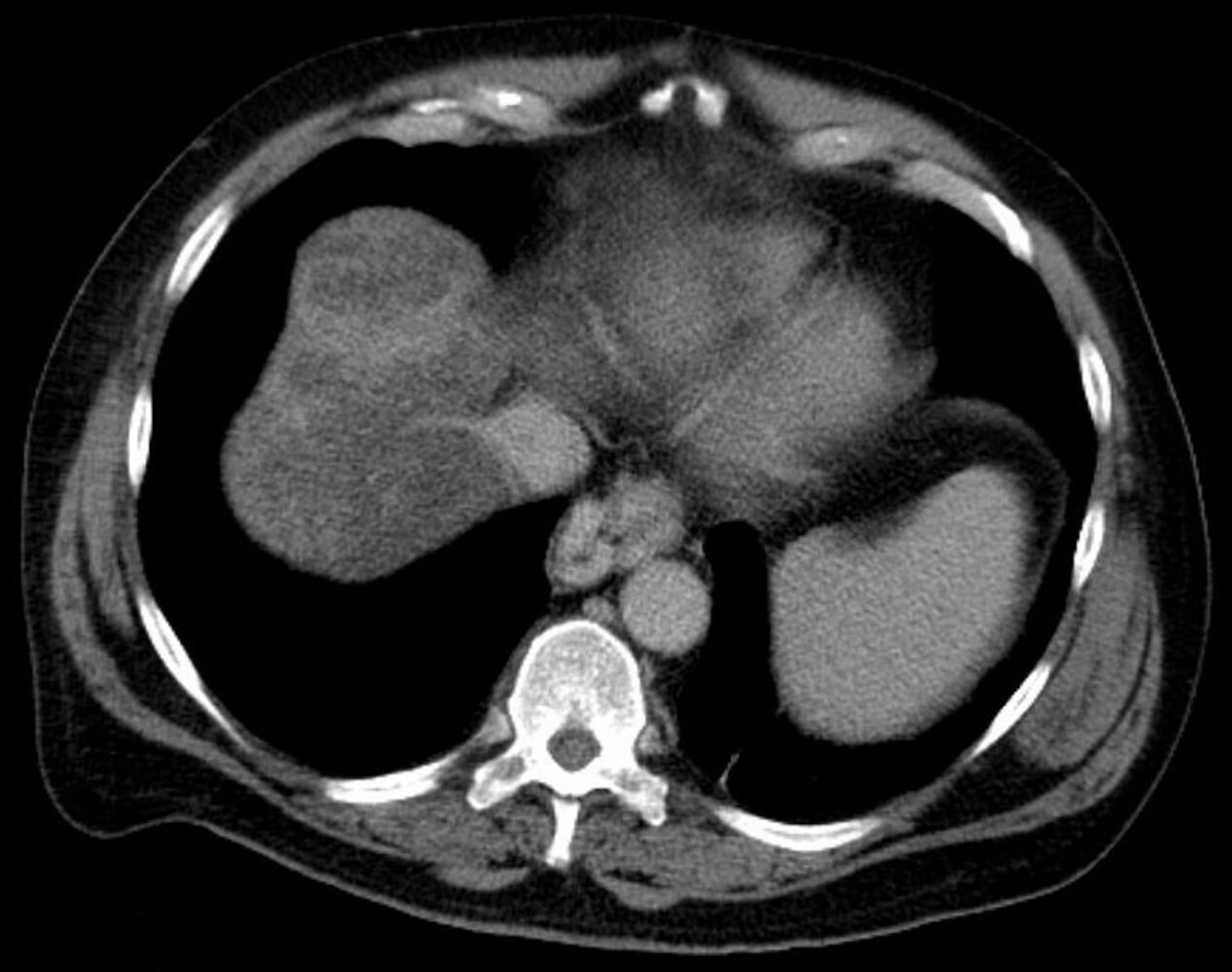Esophageal varices