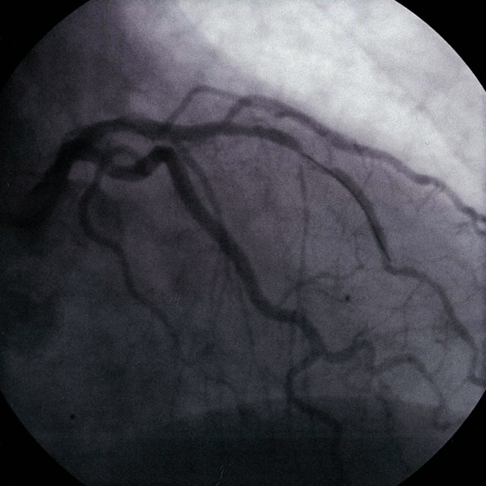 Treatment of acute anterior myocardial infarction (2/2)