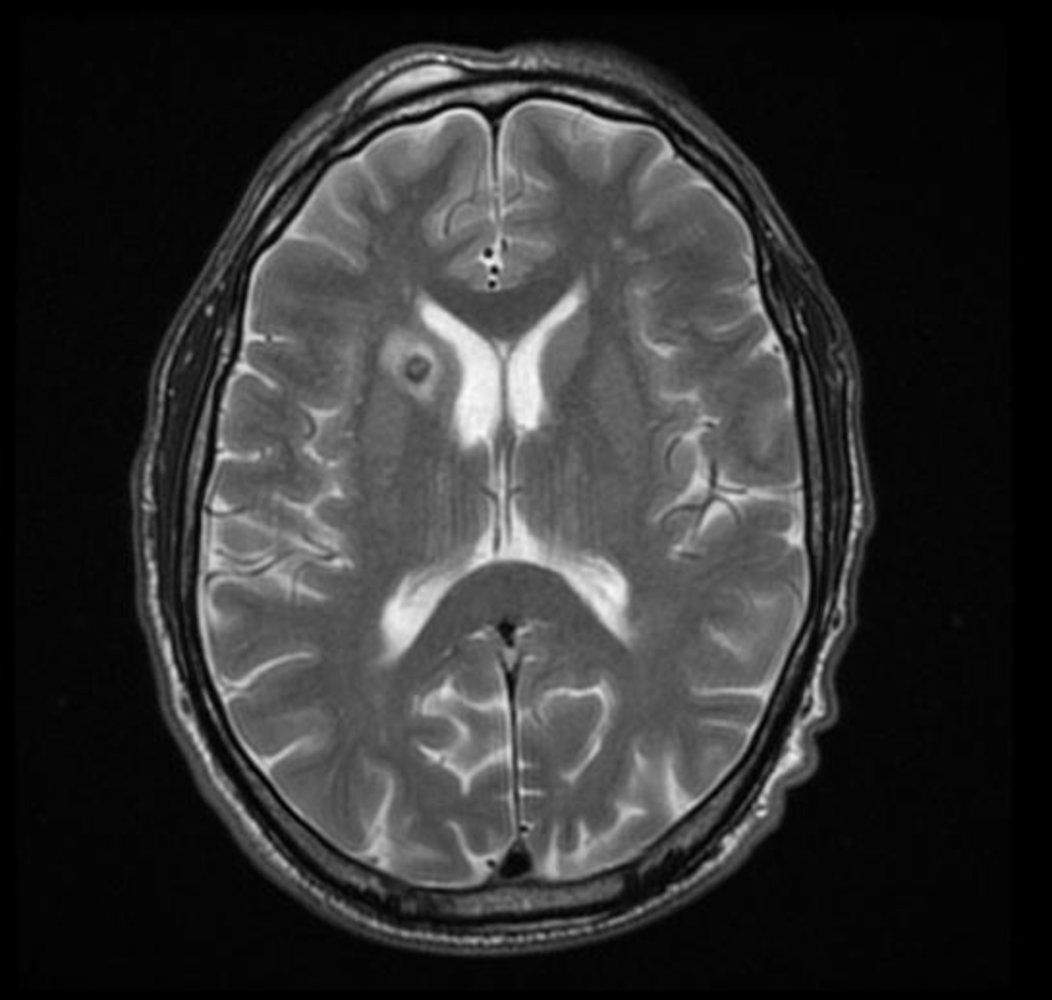 Internal capsule lesion in neurotoxoplasmosis