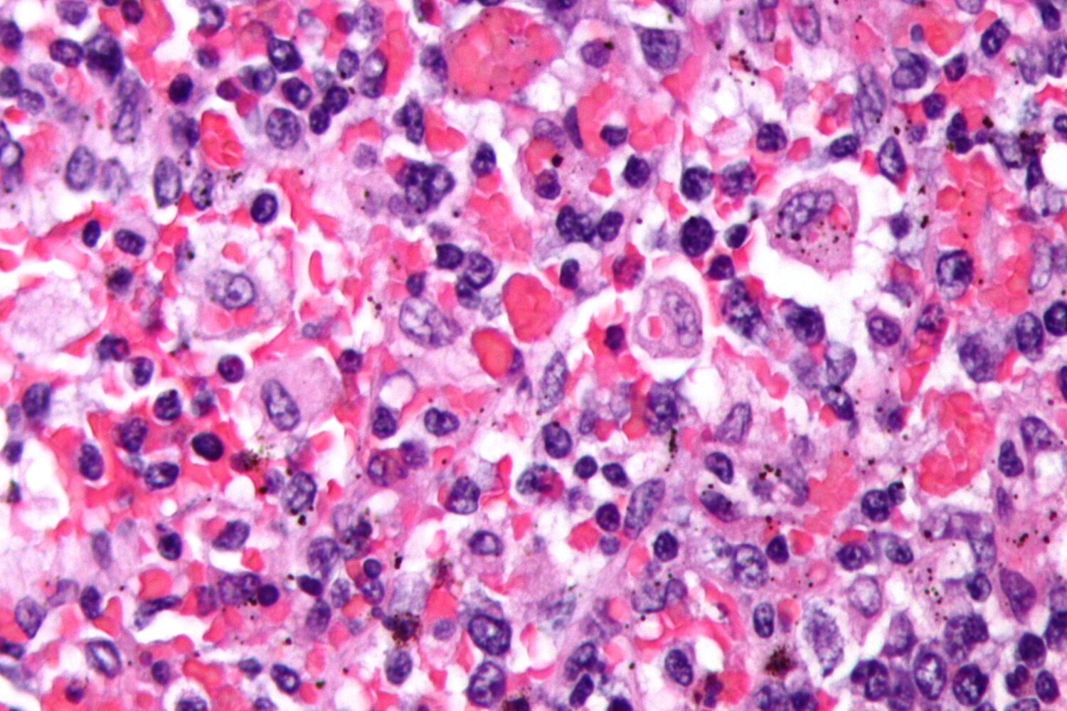 Hemophagocytosis