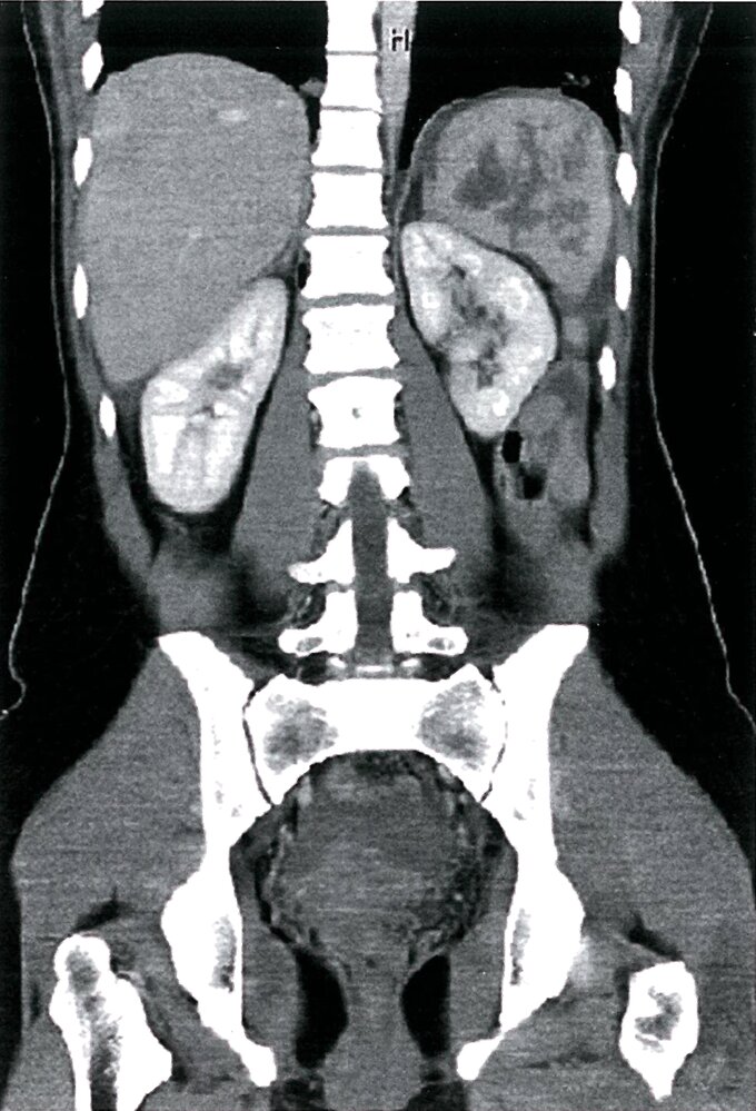Abdomen and pelvis