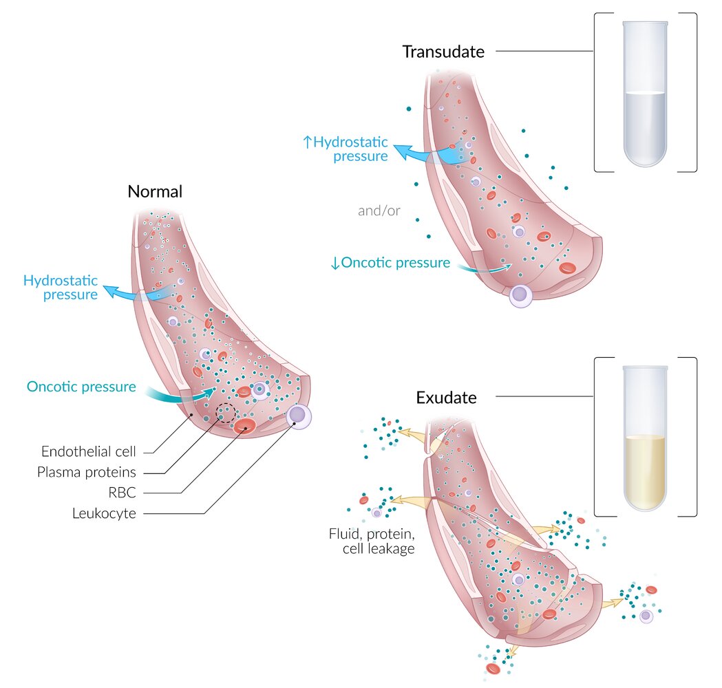 Pathophysiology of transudate versus exudate