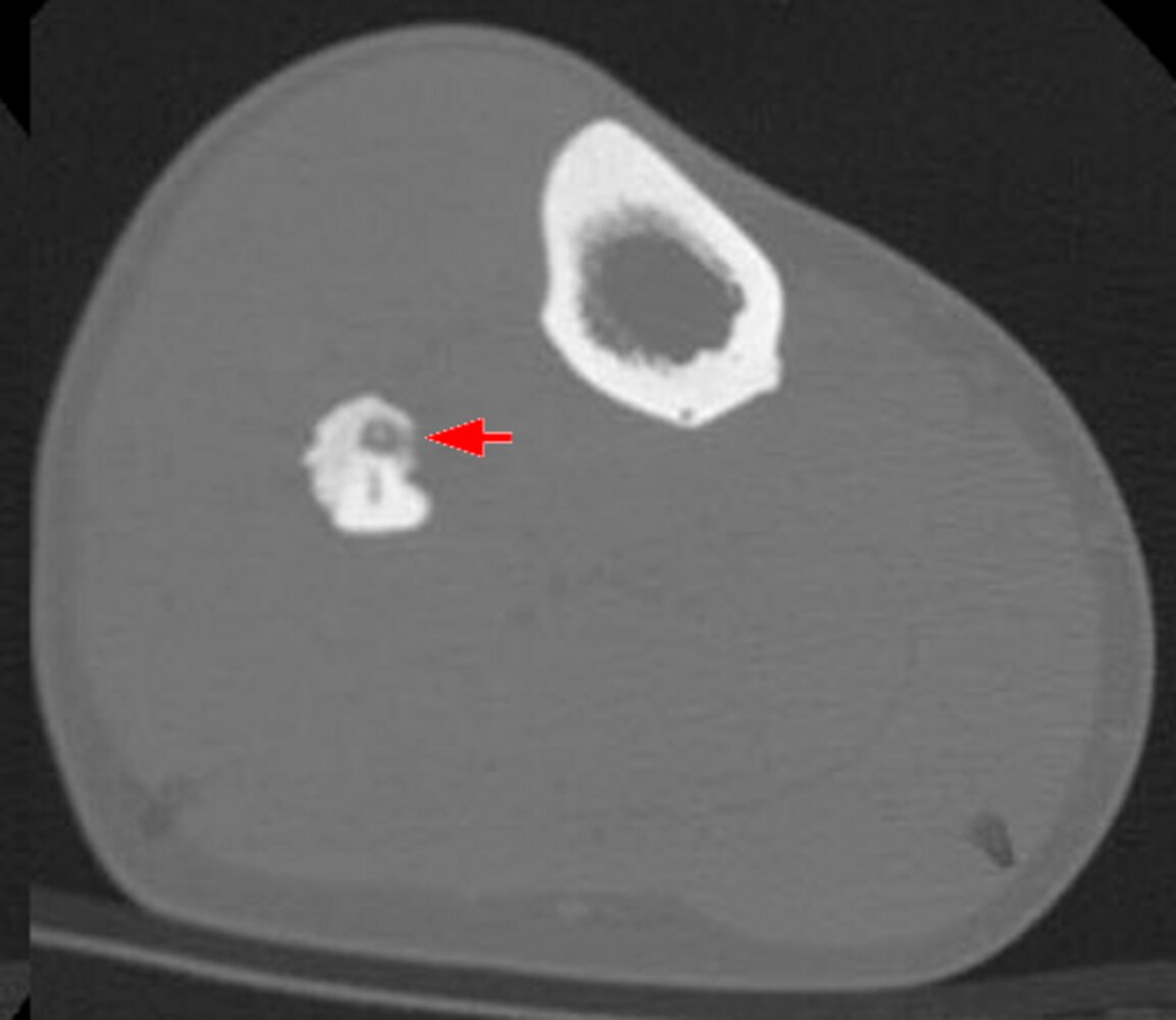 Osteoid osteoma of the fibula