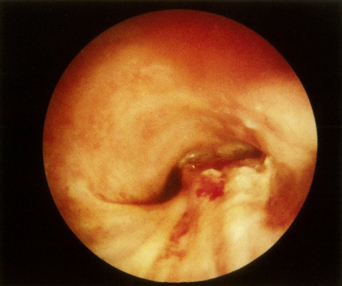 Malignant bronchial tumor