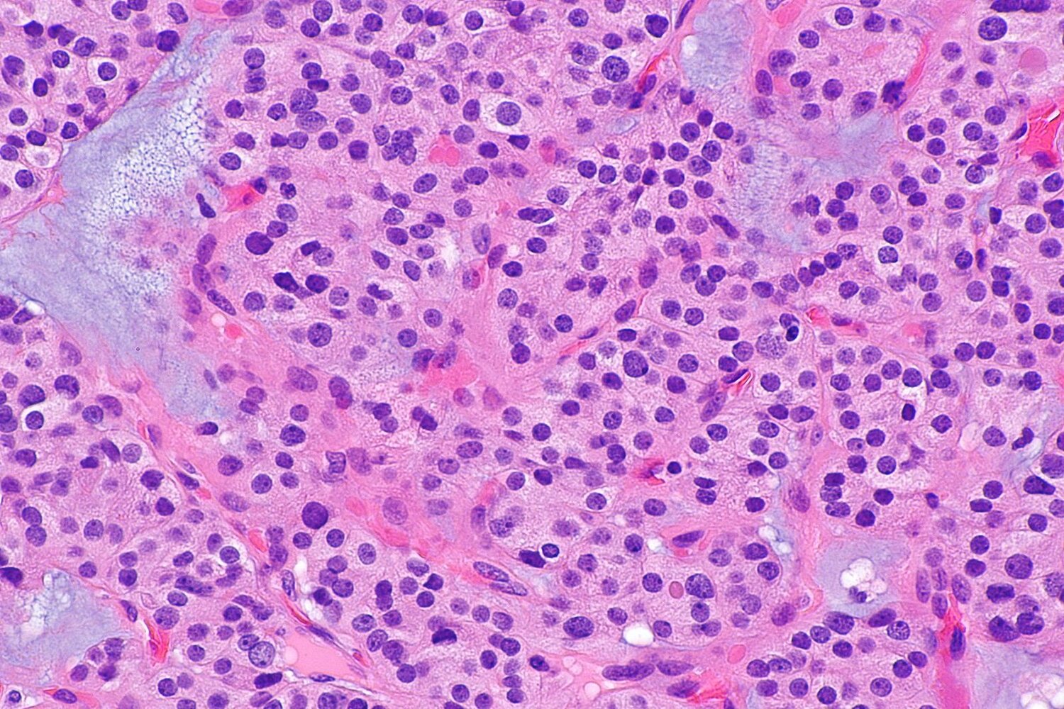 Thyroid follicular adenoma