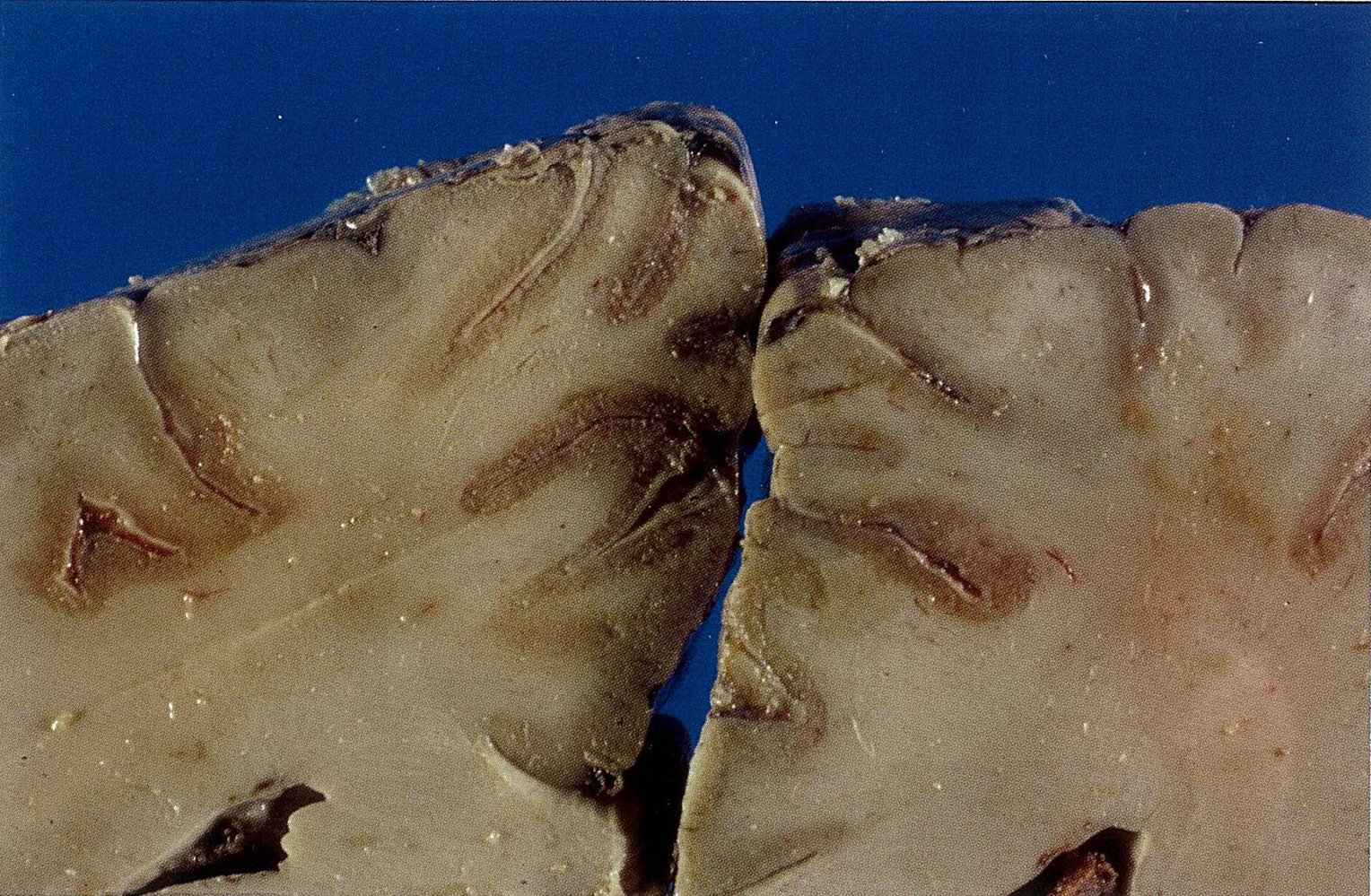 Selective neuronal necrosis