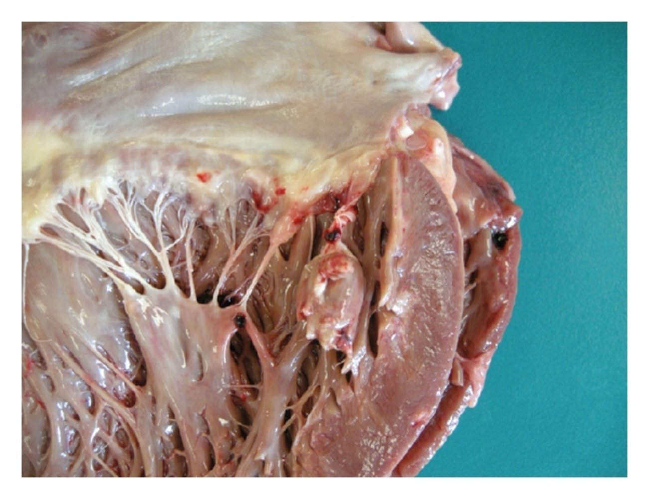 Ruptured papillary muscle