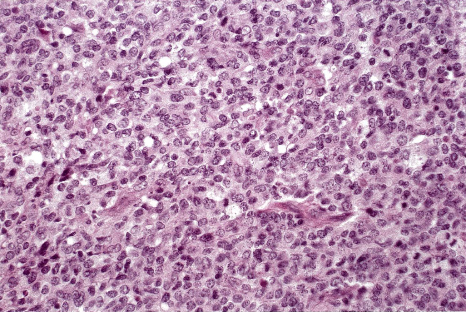 Non-Hodgkin lymphoma