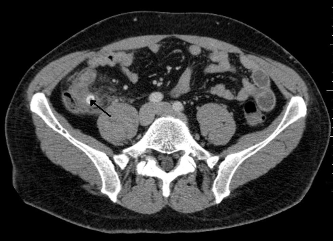 Perforated appendicitis due to fecalith