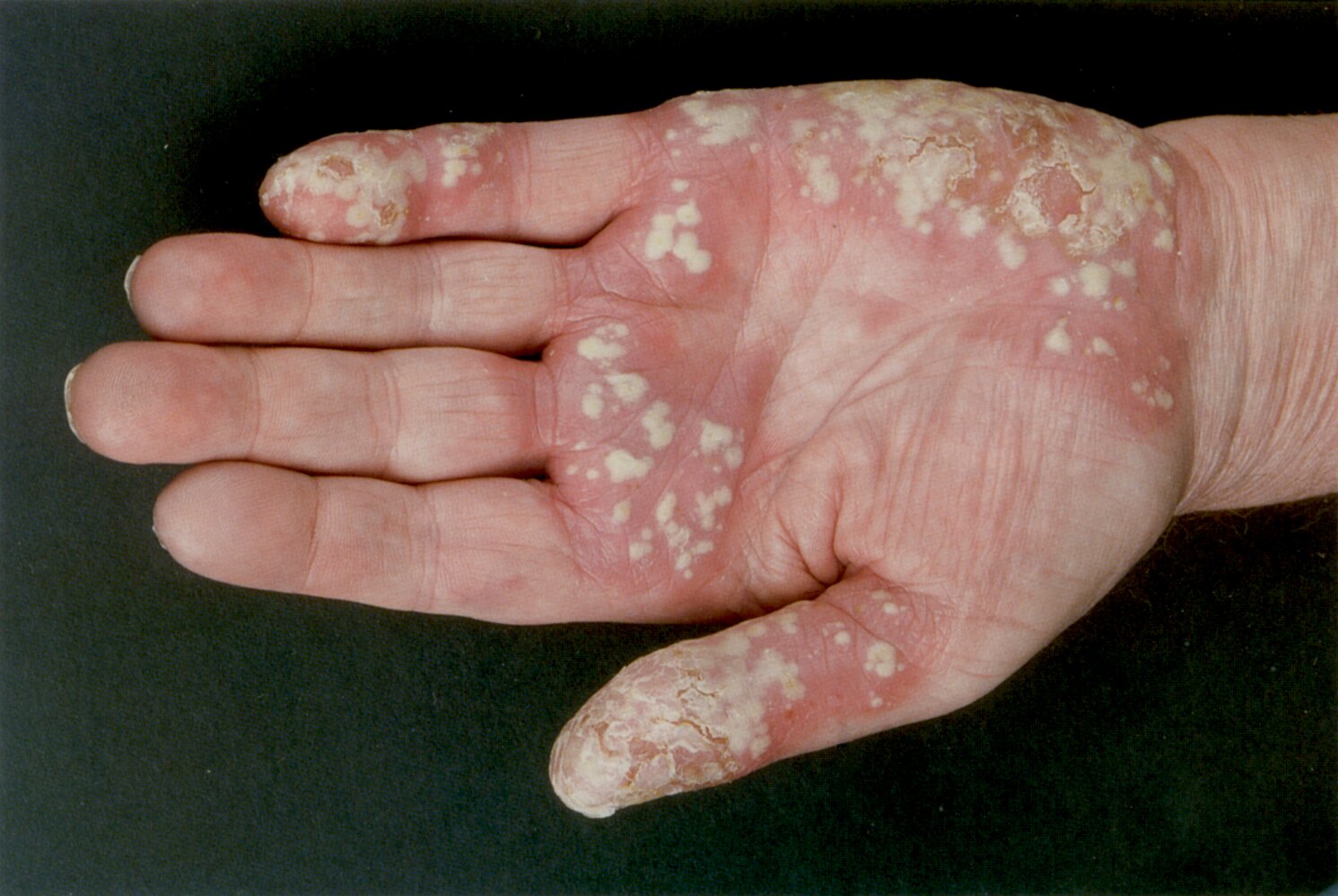 Pustular psoriasis