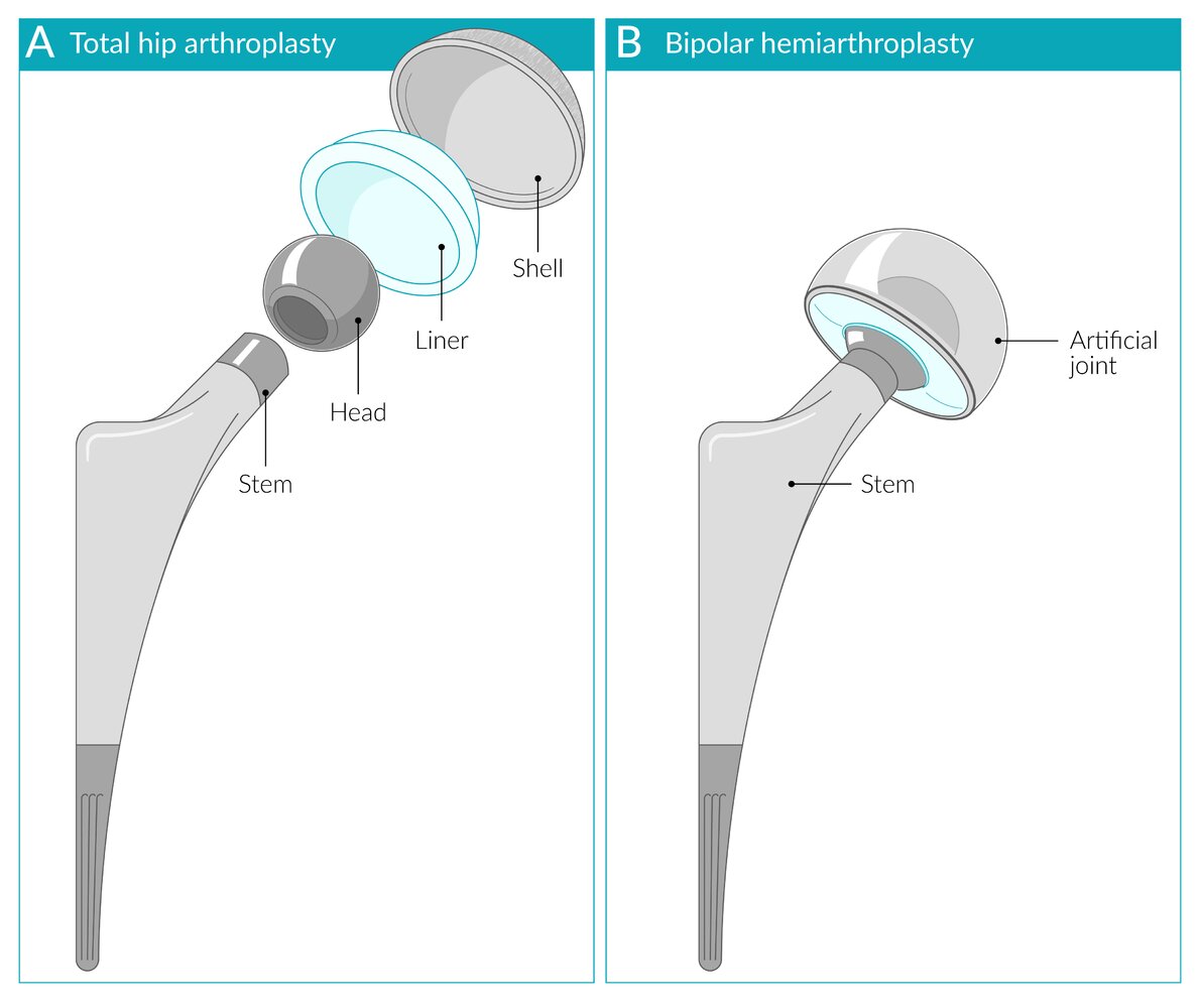 Main components of a hip prosthesis