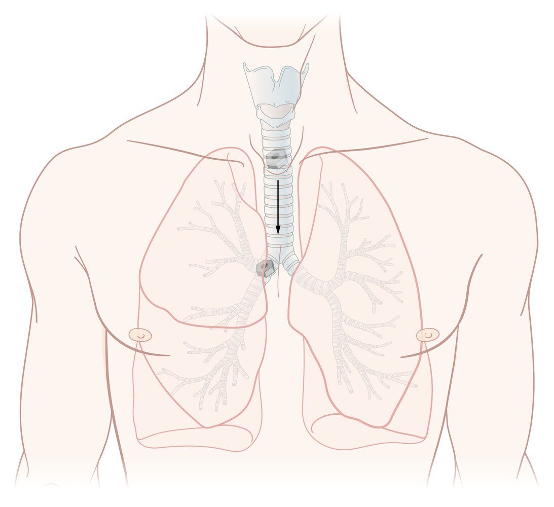Distribution of affected bronchi in foreign body aspiration