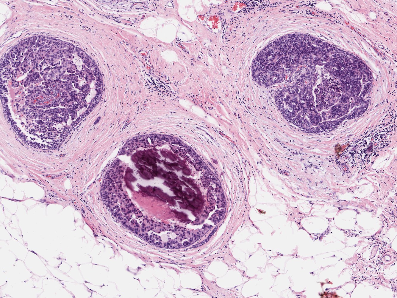 Ductal carcinoma in situ