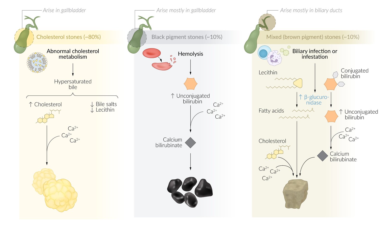 Pathophysiology for different types of gallstones
