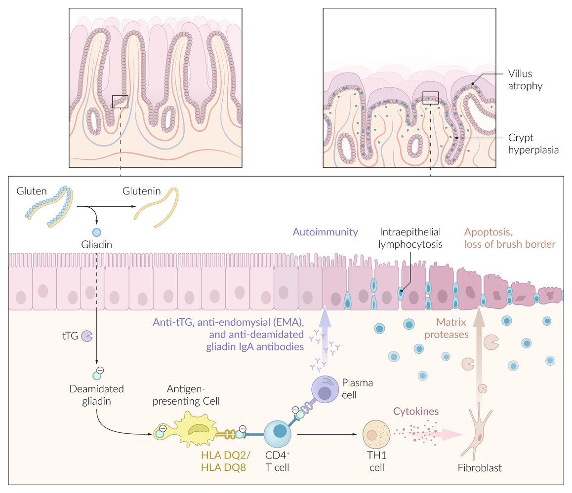 Celiac disease etiopathogenesis