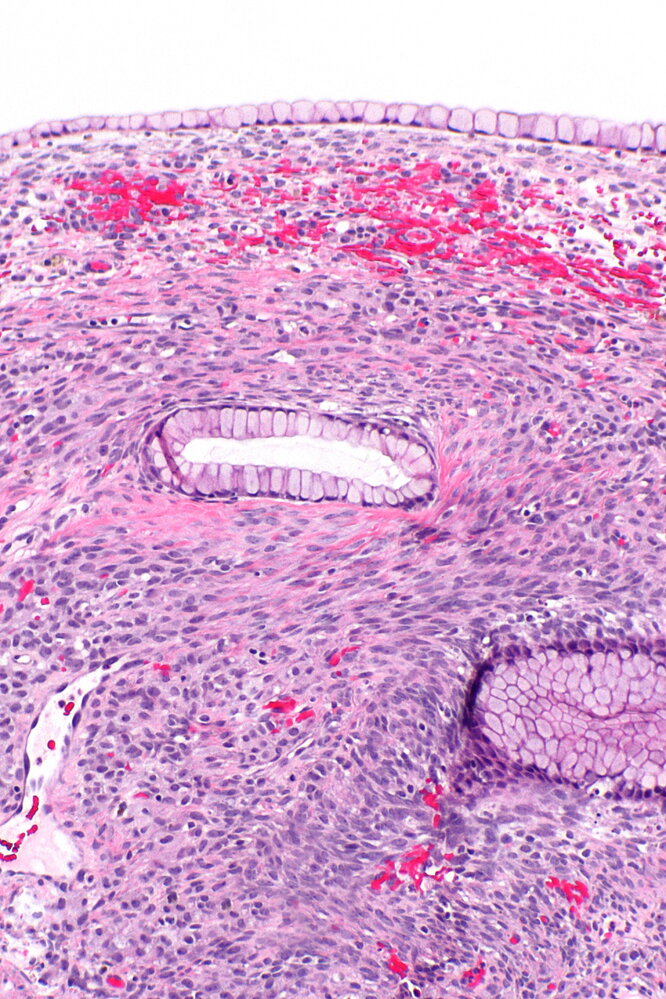 Ovarian mucinous cystadenoma